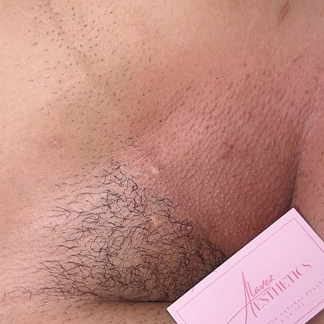 Brazilian 3x at Alavez Aesthetics in Vallejo, CA