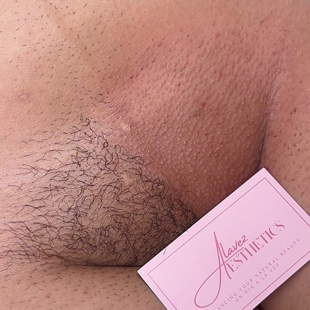 Brazilian 6x at Alavez Aesthetics in Vallejo, CA